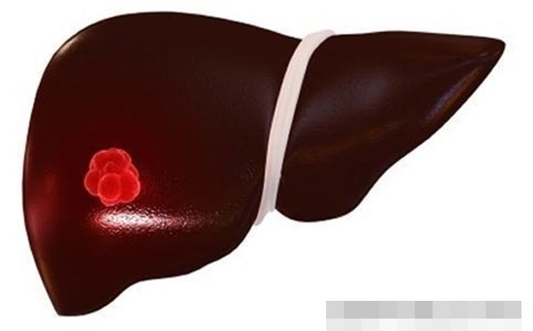 Người đàn ông qua đời sau 1 tháng phát hiện ung thư gan, bác sĩ nói thủ phạm đã xuất hiện bên cạnh 20 năm mà không biết-3