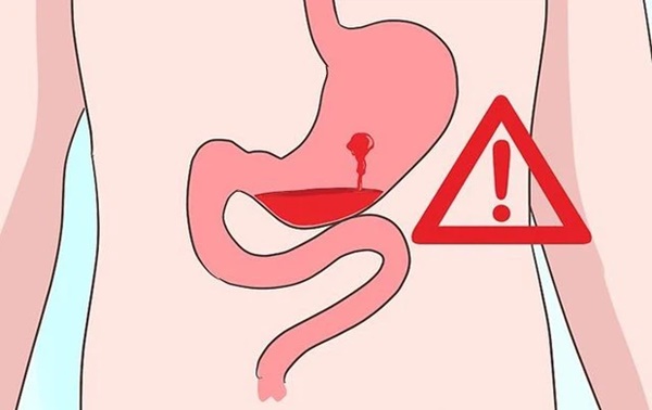 4 biểu hiện tưởng bình thường nhưng lại ngầm cảnh báo nguy cơ mắc ung thư dạ dày cao-3