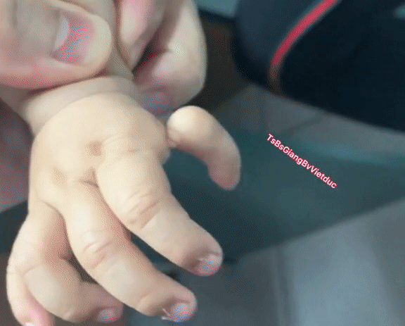 Bé trai bị dị tật ngón tay cái bẩm sinh, cả bác sĩ và bố mẹ đều thương xót nhưng nên bỏ đi hay giữ lại?-1