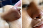 Người phụ nữ biến dạng mũi, chịu đau đớn nặng nề vì dại dột làm mẫu cho học viên spa thử nghiệm-2