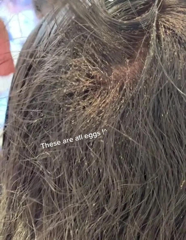 Clip: Màn diệt chấy rận ngàn con nhung nhúc trên đầu bé gái khiến 46 triệu người xem nổi da gà, chuyên gia chỉ muốn bỏ việc vì sợ-1