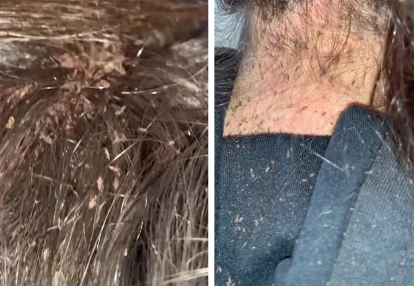 Clip: Màn diệt chấy rận ngàn con nhung nhúc trên đầu bé gái khiến 46 triệu người xem nổi da gà, chuyên gia chỉ muốn bỏ việc vì sợ-2