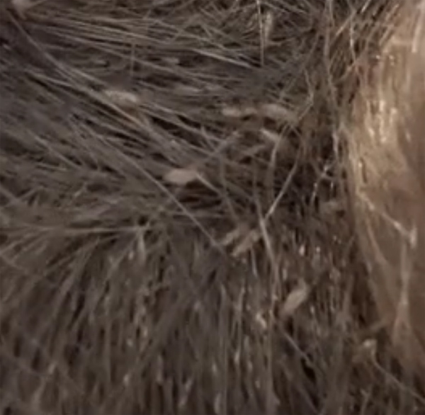 Clip: Màn diệt chấy rận ngàn con nhung nhúc trên đầu bé gái khiến 46 triệu người xem nổi da gà, chuyên gia chỉ muốn bỏ việc vì sợ-3