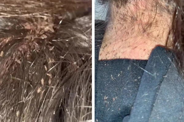 Cụ bà mang mái tóc lúc nhúc chấy đến cầu cứu, chuyên gia phải đưa ra quyết định cấp tốc trong video cực viral 76 triệu lượt xem-2