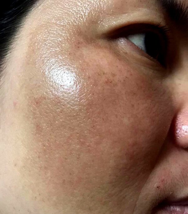 Trị nám tại nhà giúp da sáng khỏe với giá chỉ 3k-1