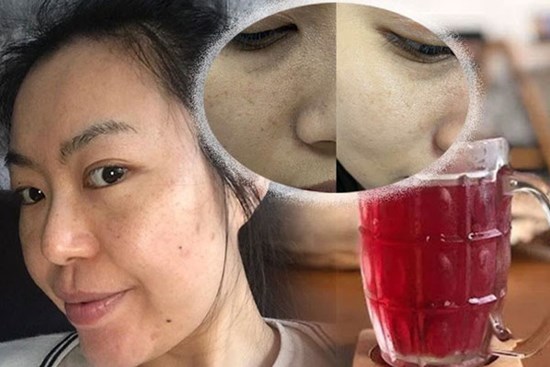 Trị nám tại nhà giúp da sáng khỏe với giá chỉ 3k