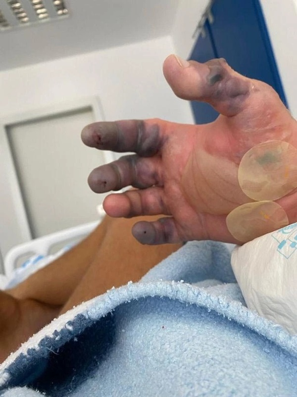 Đi biển bị sinh vật bé xíu hôn một cái, thanh niên dửng dưng không để tâm nhưng chỉ 2 tuần sau tai họa ập đến-2