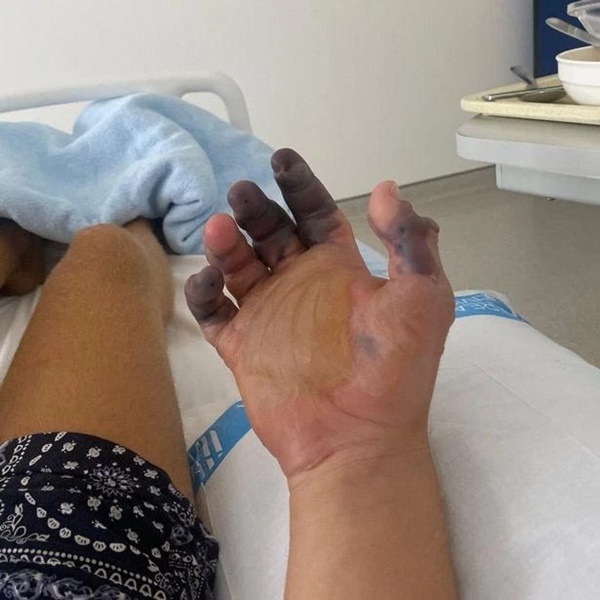 Đi biển bị sinh vật bé xíu hôn một cái, thanh niên dửng dưng không để tâm nhưng chỉ 2 tuần sau tai họa ập đến-1