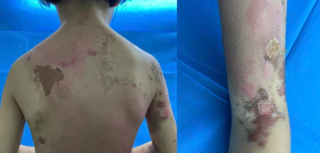 Hành động yêu thương của bà nội lại khiến đứa cháu gái 7 tuổi toàn thân nổi đầy mụn nước đau đớn, chuyện gì đã xảy ra?-4