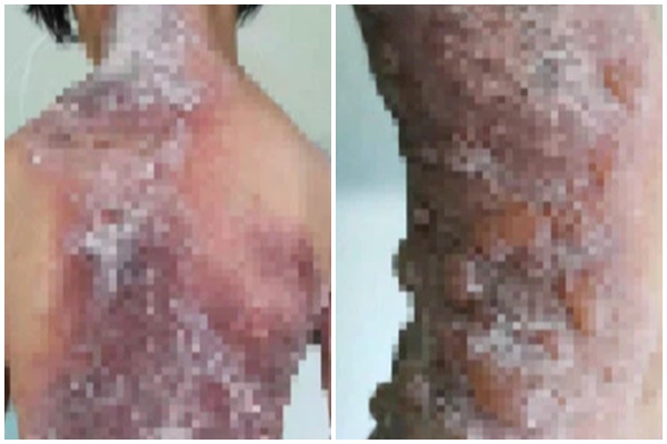 Vừa đi khỏi 10 phút, bố hoảng hốt phát hiện môi con sưng như xúc xích, tình huống hài hước nhưng tiềm ẩn nguy hiểm chết người-5