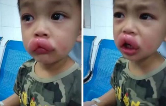 Vừa đi khỏi 10 phút, bố hoảng hốt phát hiện môi con sưng như xúc xích, tình huống hài hước nhưng tiềm ẩn nguy hiểm chết người-1