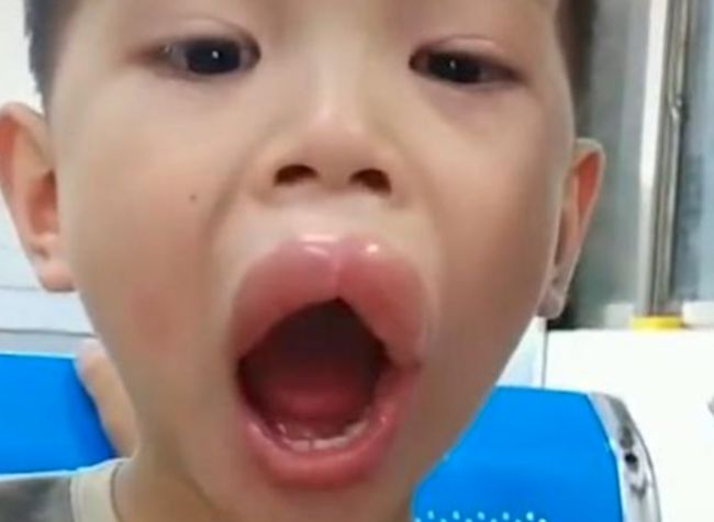 Vừa đi khỏi 10 phút, bố hoảng hốt phát hiện môi con sưng như xúc xích, tình huống hài hước nhưng tiềm ẩn nguy hiểm chết người-2