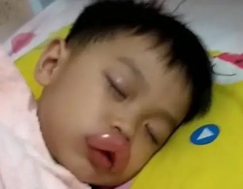 Vừa đi khỏi 10 phút, bố hoảng hốt phát hiện môi con sưng như xúc xích, tình huống hài hước nhưng tiềm ẩn nguy hiểm chết người-3