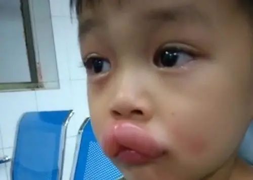 Vừa đi khỏi 10 phút, bố hoảng hốt phát hiện môi con sưng như xúc xích, tình huống hài hước nhưng tiềm ẩn nguy hiểm chết người-4