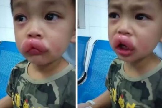 Vừa đi khỏi 10 phút, bố hoảng hốt phát hiện môi con sưng như xúc xích, tình huống hài hước nhưng tiềm ẩn nguy hiểm chết người