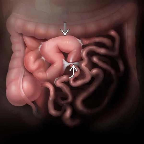 Không đói nhưng bụng vẫn réo inh ỏi có thể là dấu hiệu của bệnh gì?-3