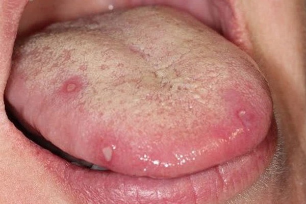 Đắng miệng vào buổi sáng có thể cảnh báo 5 cơ quan này trong cơ thể đang gặp vấn đề-4