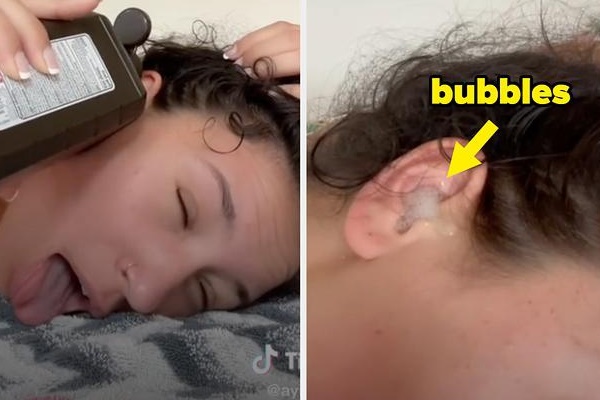 Trào lưu đổ oxy già vào tai tiềm ẩn nguy hiểm trên TikTok-1