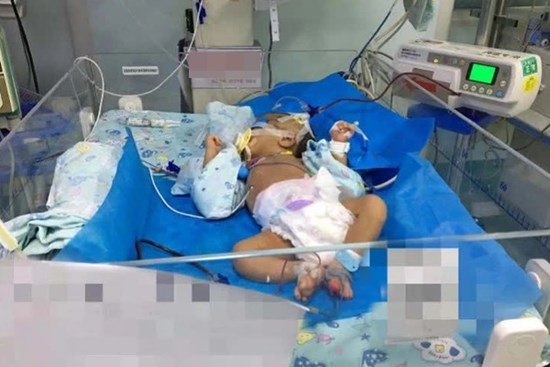 Bé trai 1 tháng tuổi bị xuất huyết não, bác sĩ cảnh báo thói quen ăn uống của mẹ có thể ảnh hưởng nghiêm trọng đến con