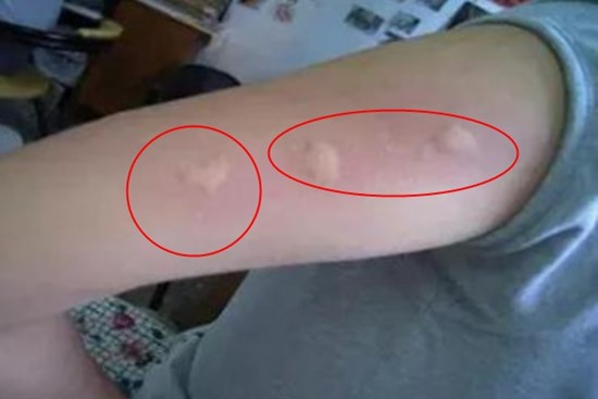 Bị muỗi đốt ngứa ngáy, khó chịu, mách bạn mẹo nhỏ, không cần mua thuốc mỡ, 1 phút là giảm ngứa nhanh và hiệu quả