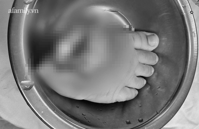 Tai nạn đau lòng: Bé trai 5 tuổi chạy chơi bị xe nâng tại nhà cắt đứt lìa bàn chân phải-1