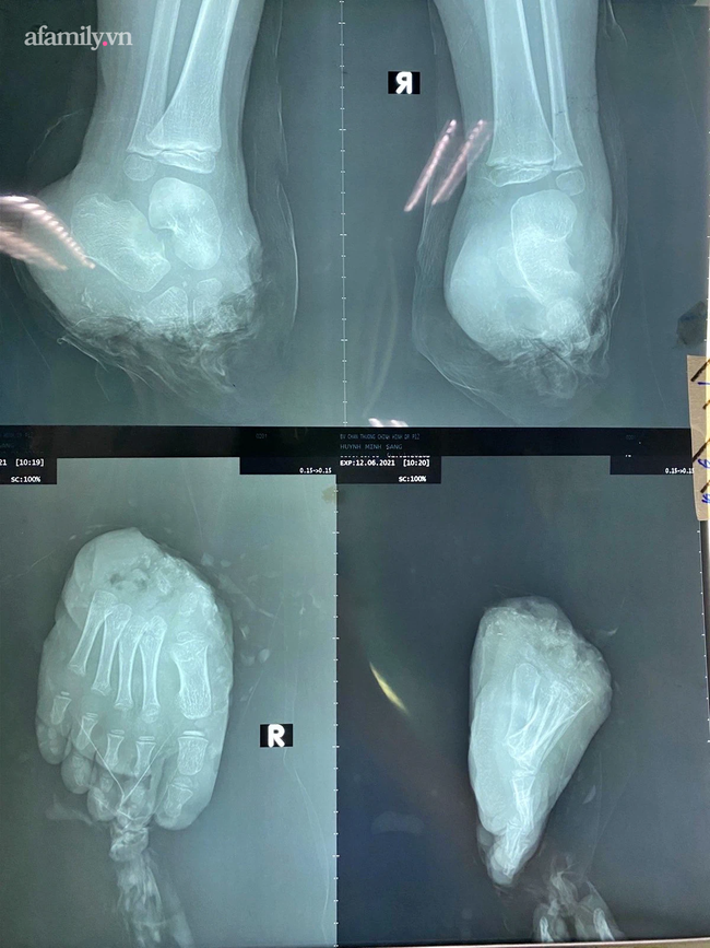 Tai nạn đau lòng: Bé trai 5 tuổi chạy chơi bị xe nâng tại nhà cắt đứt lìa bàn chân phải-2