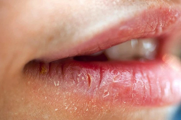 5 dấu hiệu ở miệng cho thấy gan đang bị tổn thương, nếu có dù chỉ 1 cái bạn cũng nên đi khám ngay-3