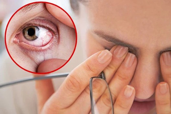 3 biểu hiện bất thường ở mắt ngầm cảnh báo gan có vấn đề, xem thử bạn có dấu hiệu nào hay không-1