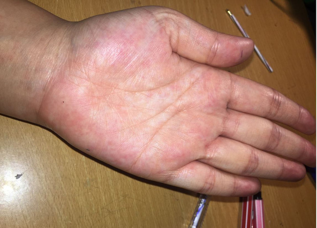 Người có gan kém thường sẽ đạt được 4 chứng bệnh không bình thường ở bàn tay, nếu không có thì gan vẫn rất mạnh bạo-1
