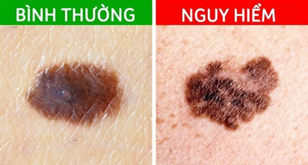 Các dấu hiệu cảnh báo ung thư đang xảy ra trên nốt ruồi trước đây là nốt ruồi lành tính-2