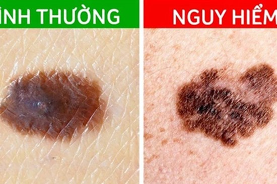 Các dấu hiệu cảnh báo ung thư đang xảy ra trên nốt ruồi trước đây là nốt ruồi lành tính