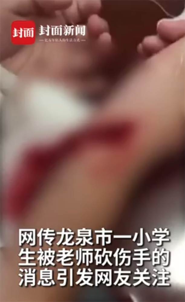 Học sinh tiểu học viết chữ xấu bị cô giáo rạch tay gây chấn động dư luận Trung Quốc-1