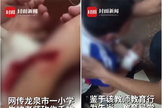 Học sinh tiểu học viết chữ xấu bị cô giáo rạch tay gây chấn động dư luận Trung Quốc