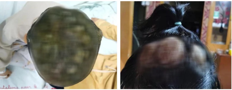 2 chị em đều bị sốt cao, trên đầu mọc lởm chởm các cục mụn mủ to bằng quả chanh, bác sĩ nhắc nhở 5 lưu ý khi có thú cưng trong nhà-1