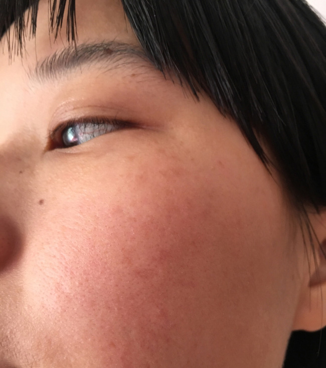 Làn da xuất hiện 5 dấu hiệu này thì chứng tỏ bạn đang bị kích ứng với mỹ phẩm đang dùng-3