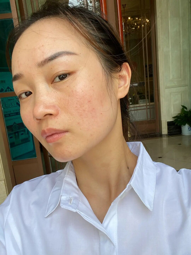 Làn da xuất hiện 5 dấu hiệu này thì chứng tỏ bạn đang bị kích ứng với mỹ phẩm đang dùng-4