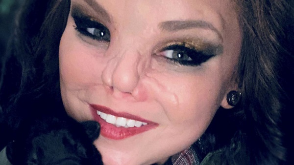 Bị chó pitbull hung dữ cắn đứt lìa mũi ra khỏi mặt, người phụ nữ chia sẻ hình ảnh diện mạo mới ở hiện tại sau 4 năm gây bất ngờ-6