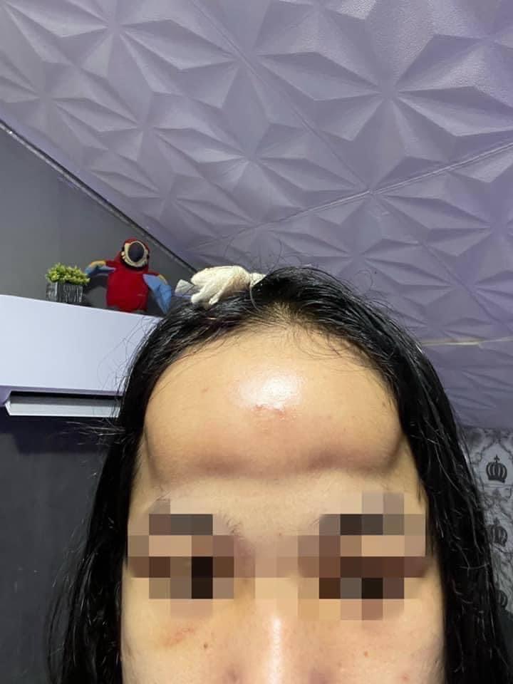 Vừa buồn cười vừa thương cô gái độn trán như ổi rơi trúng đầu-4