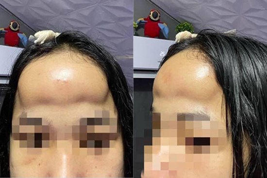 Vừa buồn cười vừa thương cô gái độn trán như ổi rơi trúng đầu