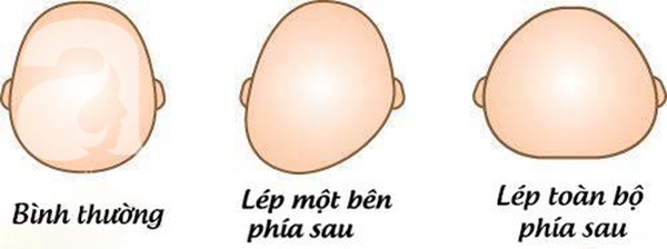 Đừng để trẻ ngủ với ba tư thế này, không chỉ ảnh hưởng đến hình dạng của hộp sọ mà sự phát triển của não bộ cũng bị hạn chế-3
