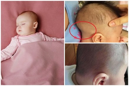 Đừng để trẻ ngủ với ba tư thế này, không chỉ ảnh hưởng đến hình dạng của hộp sọ mà sự phát triển của não bộ cũng bị hạn chế