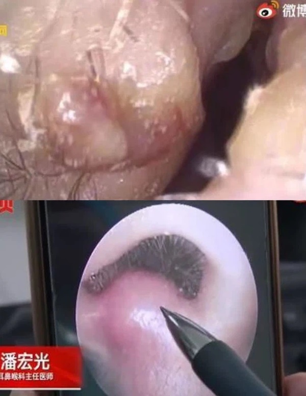 Bé trai 8 tuổi đột ngột sốt cao, nôn mửa, đi cấp cứu mới biết bị nhiễm trùng não chỉ vì thói quen tưởng vô hại-1