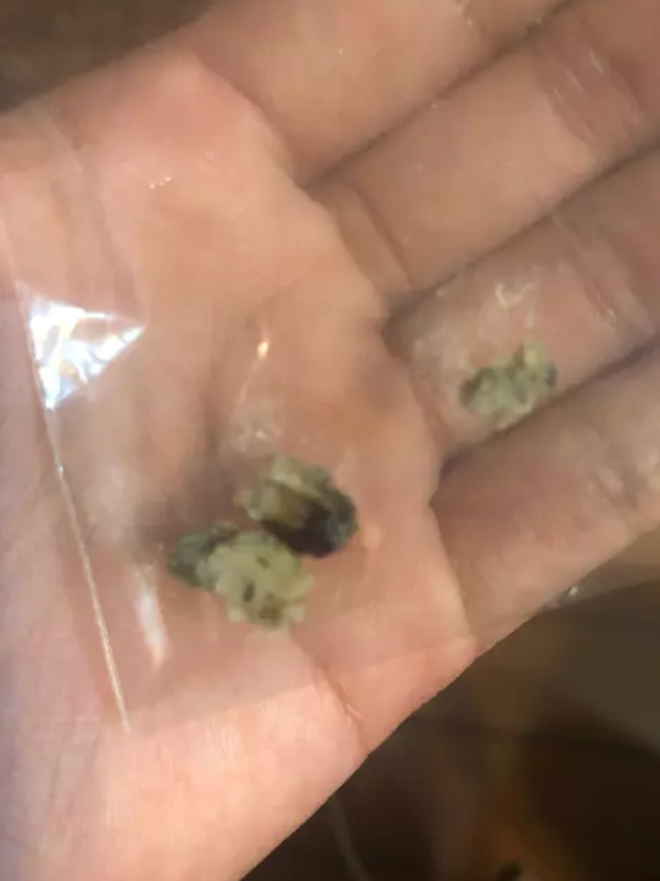 Cô gái Đài Loan sau khi đau nhức bụng phát hiện có dị vật màu đen ở rốn, vừa đen, vừa hôi, bác sĩ nhìn thấy cũng phải cạn lời-4