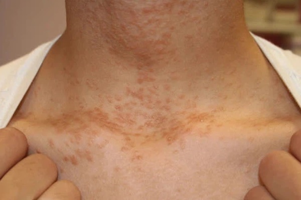 3 bất thường ở cổ cho thấy nguy cơ mắc ung thư cao nhưng thường bị mọi người bỏ qua-1