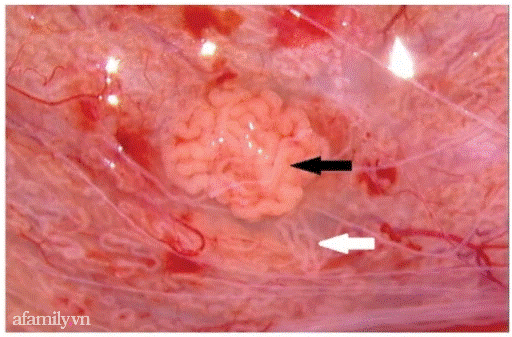 Ths. BS Đinh Hữu Việt: Người chồng không có tinh trùng nhưng nhờ kỹ thuật vi phẫu tinh hoàn, hai vợ chồng đón cặp song sinh sau nhiều năm chờ đợi-11