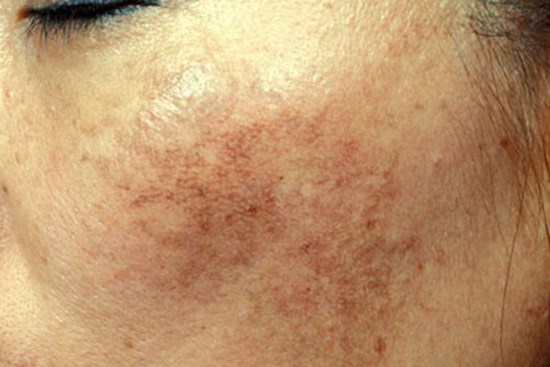 4 sai lầm nghiêm trọng khiến da bạn mãi xỉn màu, không thể sáng lên tông nào dù vất vả skincare