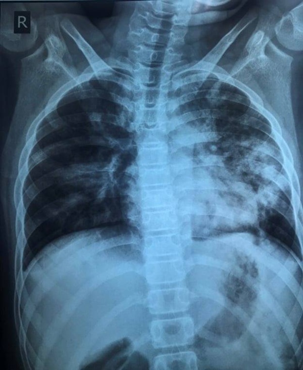 Trẻ 13 tuổi mắc Covid-19 tổn thương phổi nặng dù không có bệnh nền-1