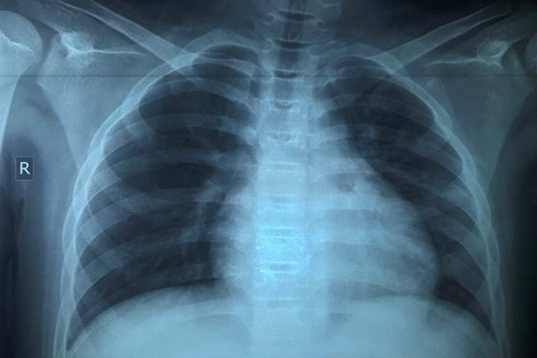 Trẻ 13 tuổi mắc Covid-19 tổn thương phổi nặng dù không có bệnh nền-2
