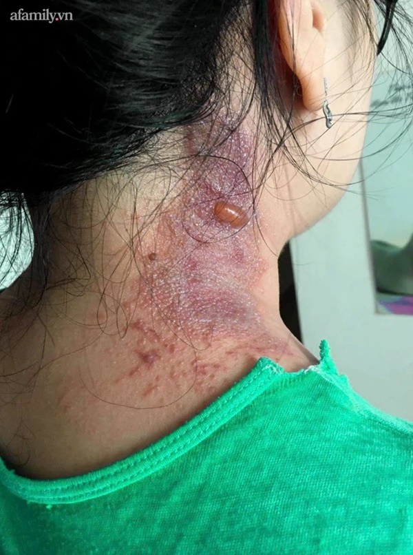 Viêm da vì kiến ba khoang, nhiều bệnh nhân gánh hậu quả mùa dịch-1