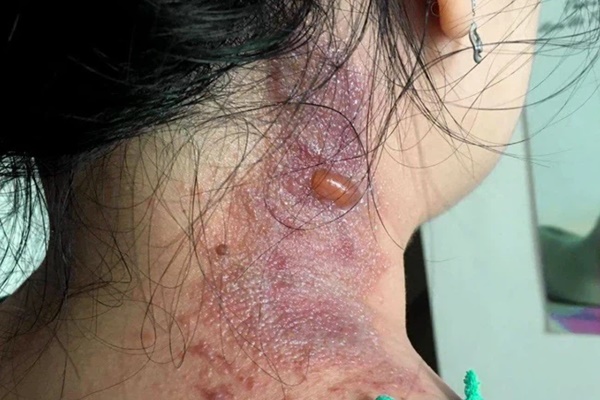 Đau rát do kiến ba khoang nhưng bị nhầm là Zona, bác sĩ chỉ cách phân biệt-3